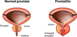 dysuria prostatitis